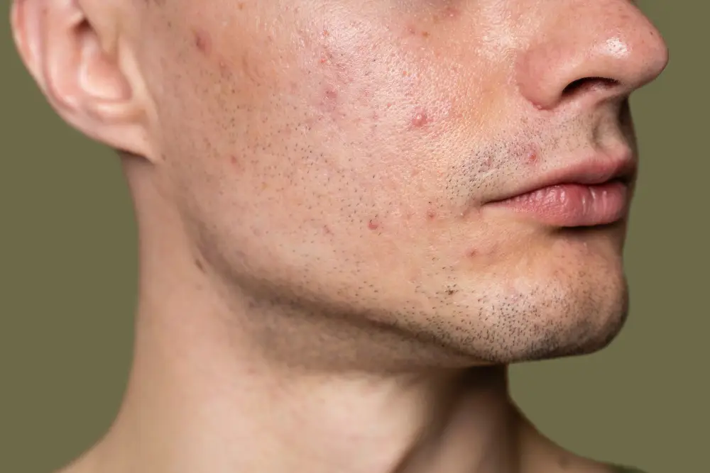 Acupuncture for hormonal acne