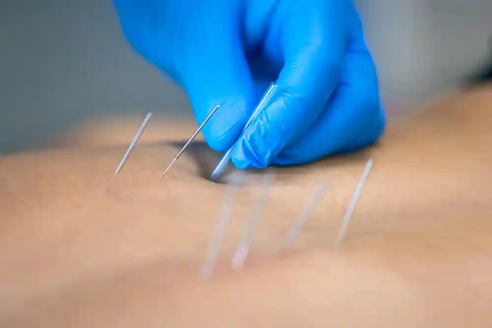Acupuncture for Migraines